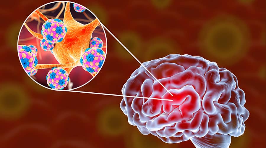 Infectious Diseases A To Z Encephalitis Elite Learning