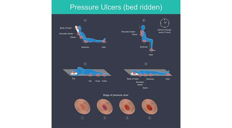 Top 7 Reasons Pressure Ulcer Rates are Still Going Up in Hospitals