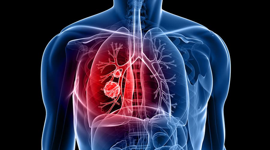 Study: Pump Inhibitors Can Increase Risk of Death in Lung Cancer Patients